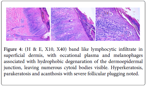 clinical-dermatology-cytoid-bodies