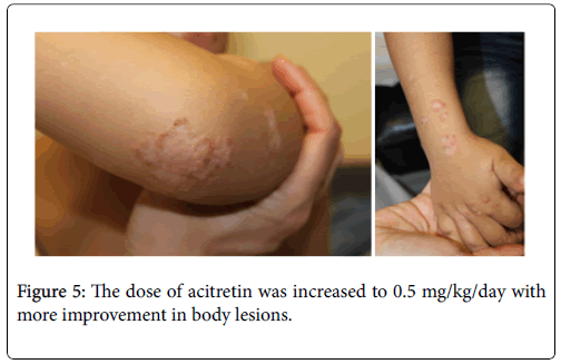 clinical-dermatology-cytoid-bodies