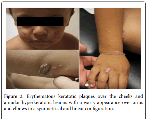 clinical-dermatology-keratotic-plaques