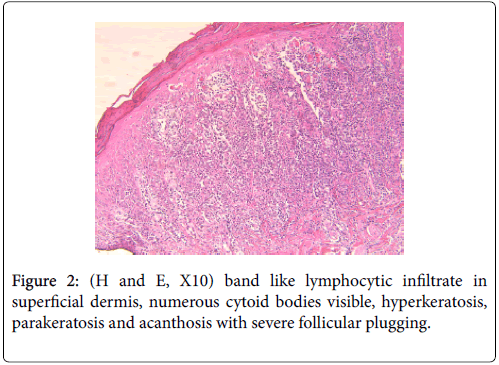 clinical-dermatology-lymphocytic