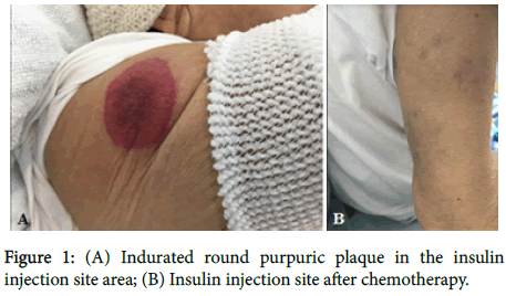 clinical-experimental-dermatology-Insulin