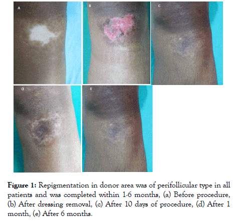 clinical-experimental-dermatology-Repigmentation-donor