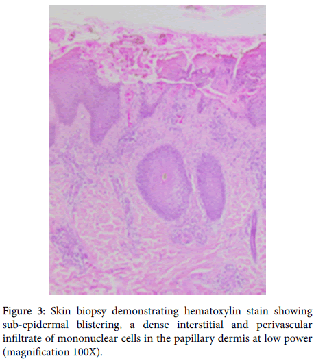 clinical-experimental-dermatology-Skin-biopsy