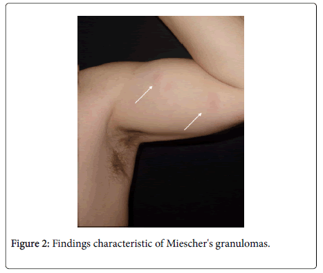 clinical-experimental-dermatology-granulomas