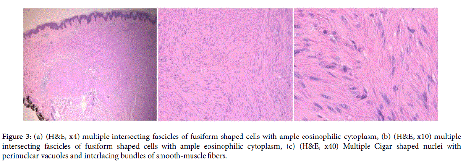 clinical-experimental-dermatology-intersecting-fascicles