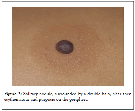 clinical-experimental-dermatology-nodule