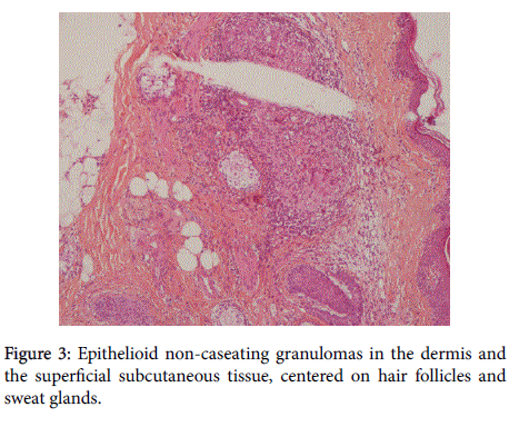 clinical-experimental-dermatology-non-caseating-granulomas