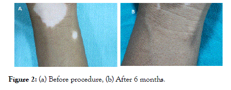 High Frequency Ultrasound in Aesthetic Dermatology Novel Research