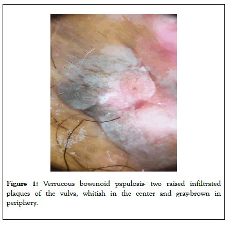 clinical-experimental-dermatology-research-bowenoid