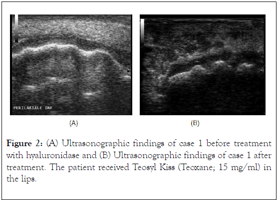 clinical-experimental-dermatology-research-hyaluronidase