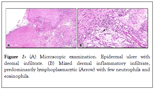 clinical-experimental-dermatology-research-infiltrate