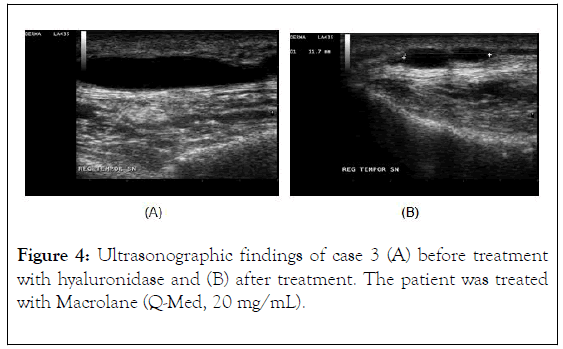 clinical-experimental-dermatology-research-macrolane