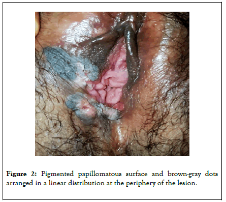 clinical-experimental-dermatology-research-papillomatous