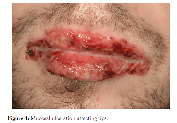 clinical-experimental-dermatology-research-ulceration