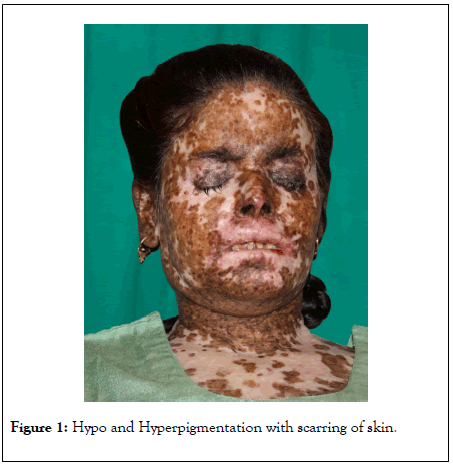 clinical-experimental-dermatology-scarring