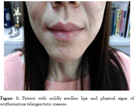 clinical-experimental-dermatology-swollen-lips