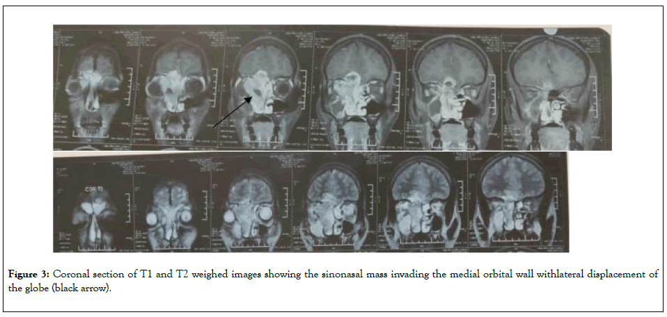 clinical-experimental-ophthalmology-Coronal