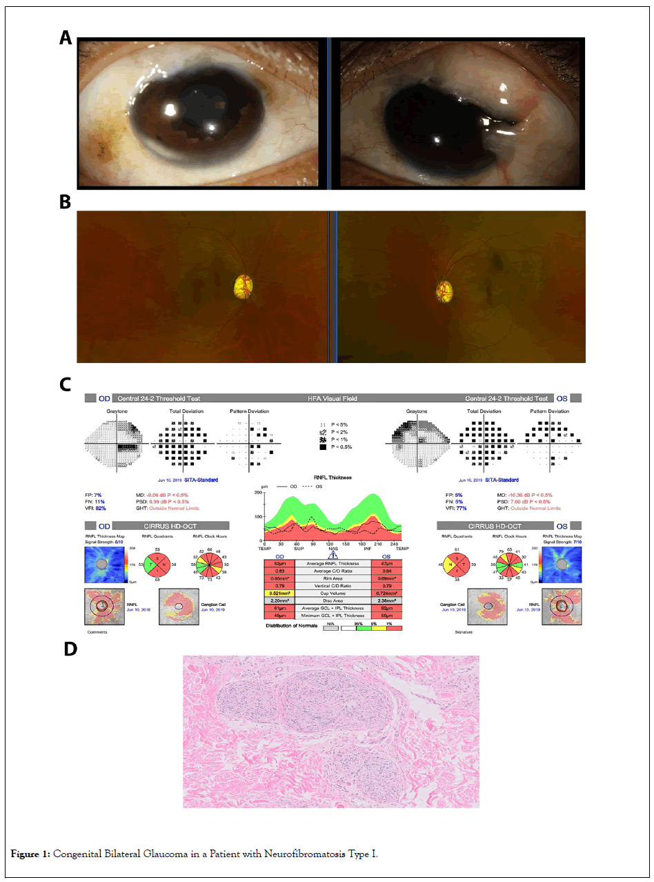 clinical-experimental-ophthalmology-Glaucoma