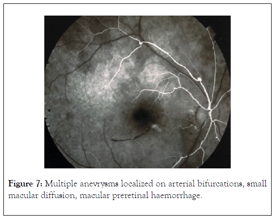 clinical-experimental-ophthalmology-anevrysms