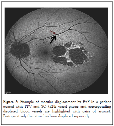 clinical-experimental-ophthalmology-displacement