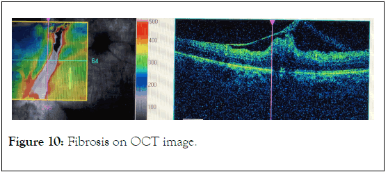 clinical-experimental-ophthalmology-fibrosis