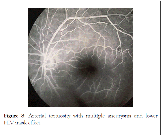 clinical-experimental-ophthalmology-tortuosity