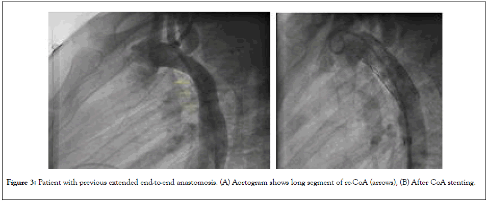 clinical-trials-stenting