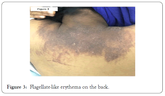 dermatology-research-Flagellate