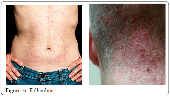 dermatology-research-Folliculitis
