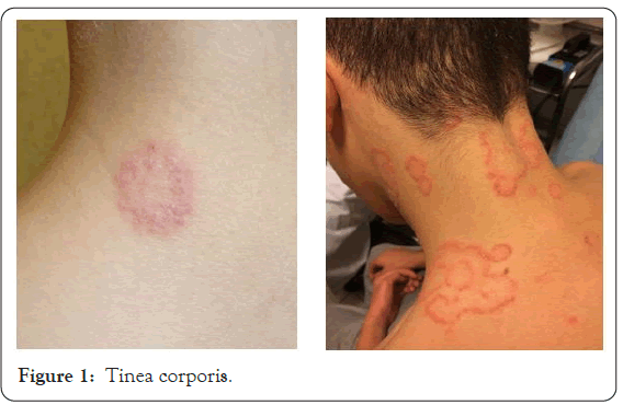 dermatology-research-Tinea