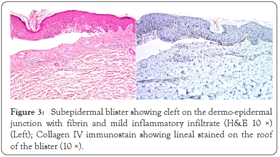 dermatology-research-blister