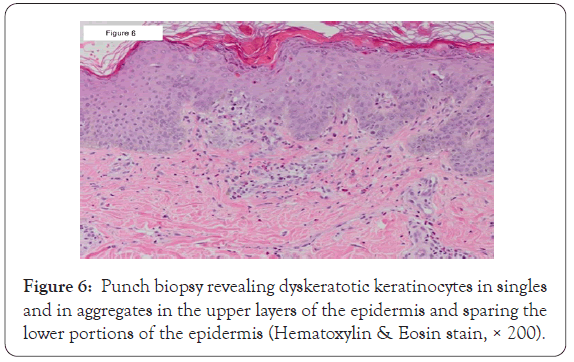 dermatology-research-dyskeratotic