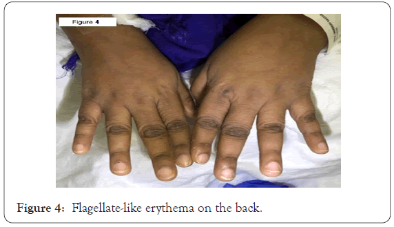 dermatology-research-erythema