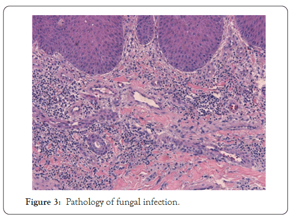 dermatology-research-fungal