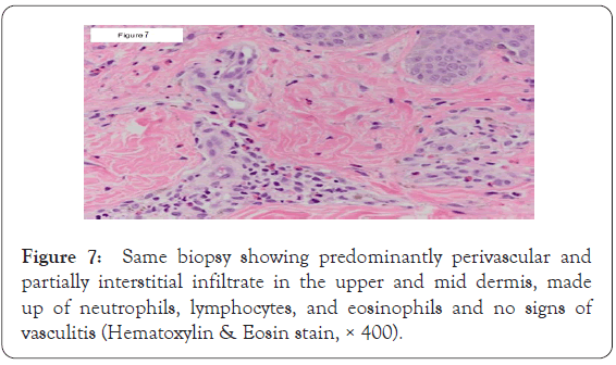 dermatology-research-infiltrate