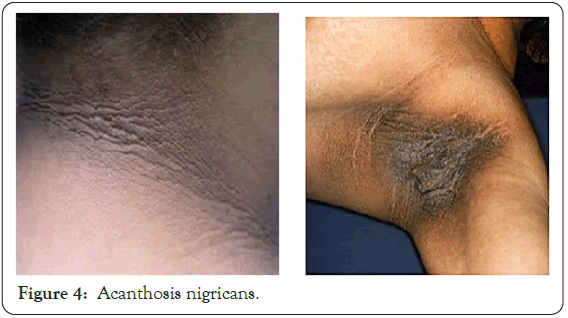 dermatology-research-nigricans