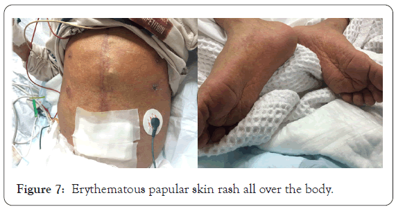 dermatology-research-papular