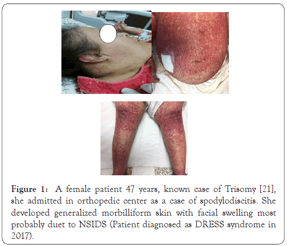 dermatology-research-spodylodiscitis