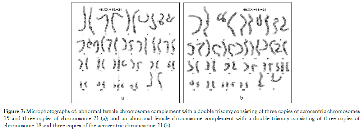 down-syndrome-abnormal-female