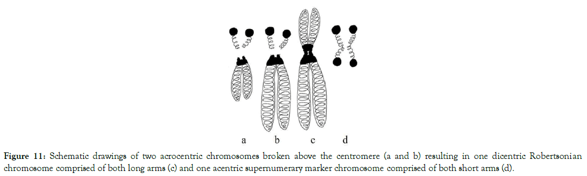 down-syndrome-acentric-supernumerary