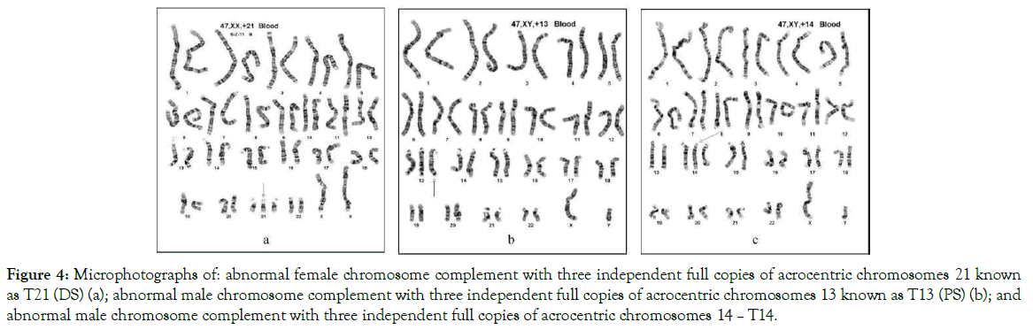 down-syndrome-female-chromosome