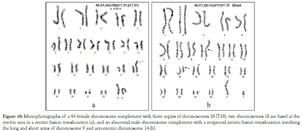 down-syndrome-hromosome-complement