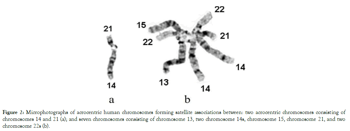 down-syndrome-human-chromosomes