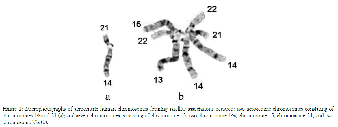 13q deletion syndrome - Wikipedia