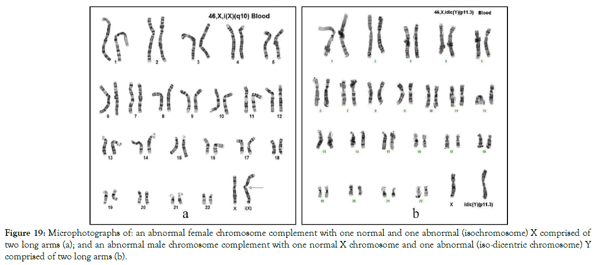 down-syndrome-iso-dicentric-chromosome