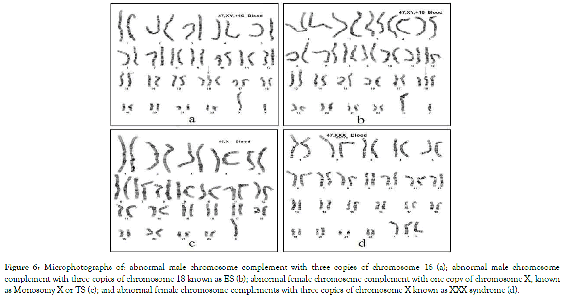 down-syndrome-male-chromosome