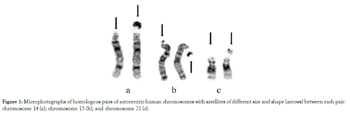 Figure 1 from Pre- and Postnatal Analysis of Chromosome 15q26.1 and 8p23.1  Deletions in Congenital Diaphragmatic Hernia | Semantic Scholar