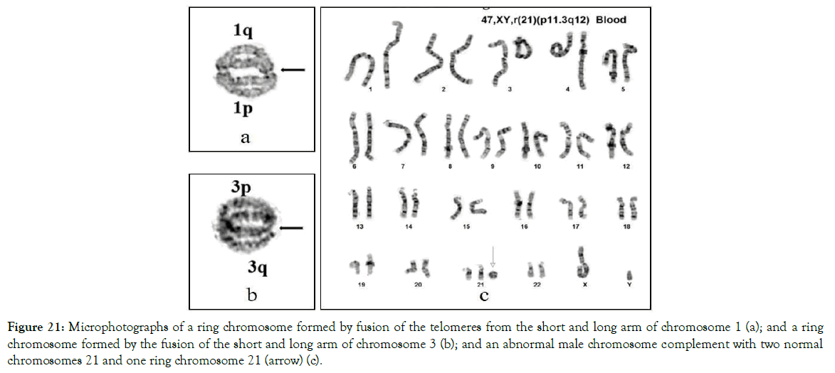 Chromosomal Abnormalities | Anthroholic