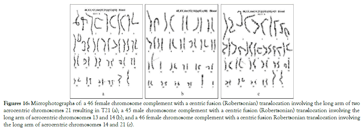 down-syndrome-robertsonian