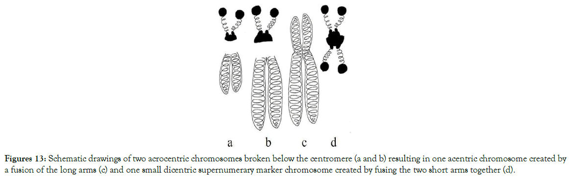 down-syndrome-short-arms